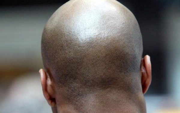 Ritualists Now Target Bald Men, Believe Their Heads Contain Gold – Police Warns