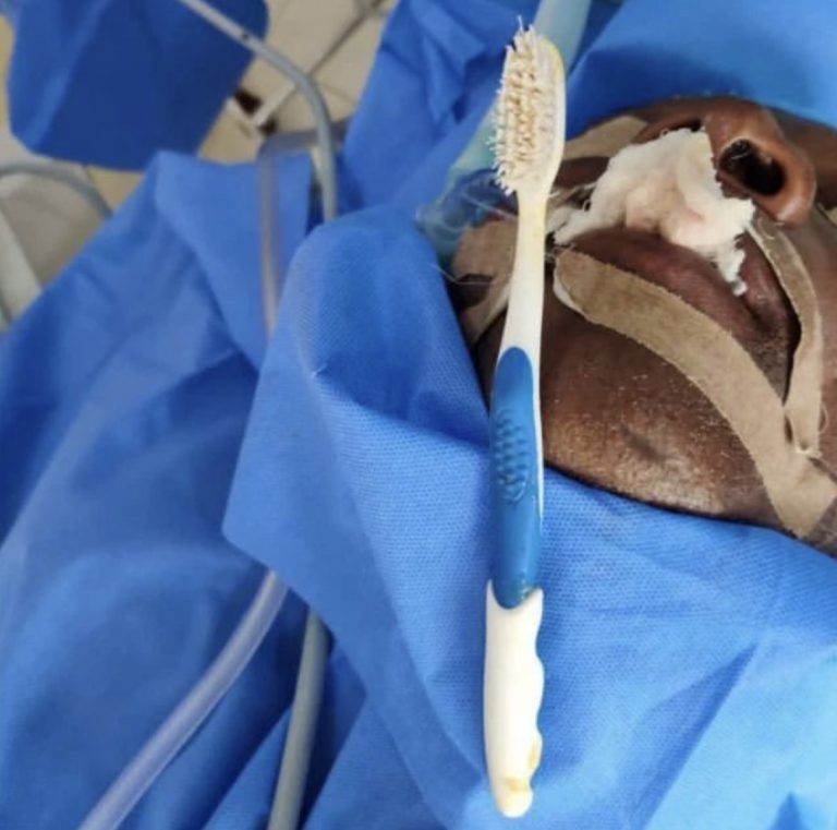 FMC Abeokuta Successfully Remove Tooth Brush Lodged In The Throat Of Patient | MarvelTvUpdates