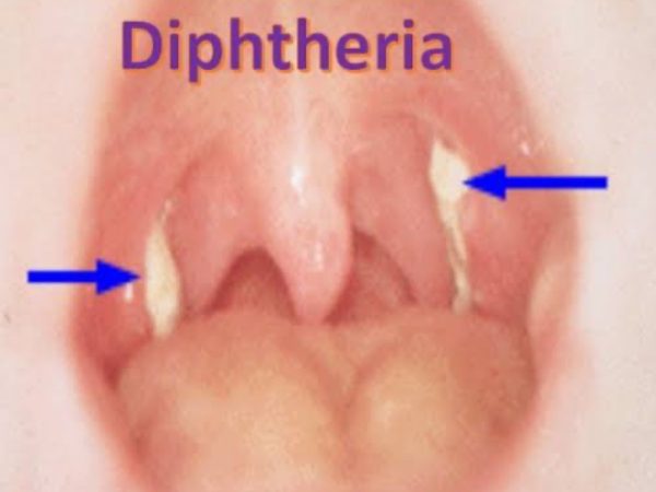 Nigeria Confirms Diphtheria Killed 1,191 In 17 Months | MarvelTvUpdates