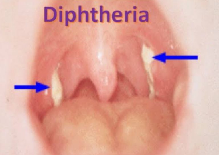 Nigeria Confirms Diphtheria Killed 1,191 In 17 Months | MarvelTvUpdates